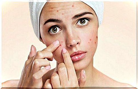 Woman experiencing cystic acne