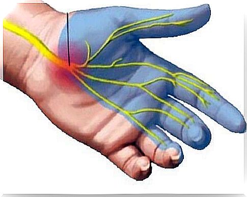 Exercises for carpal tunnel syndrome