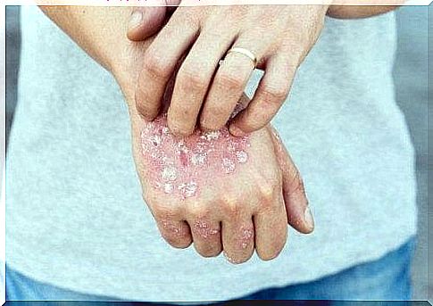 5 herbal treatments for psoriasis