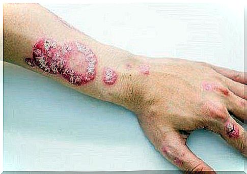 The need for herbal treatments for psoriasis on the hand