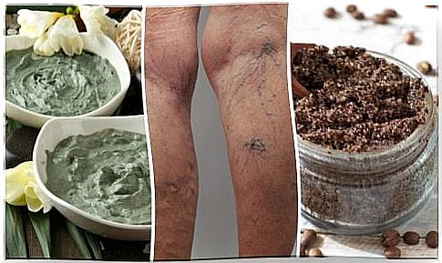 6 natural remedies against varicose veins