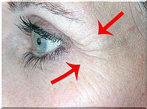 Goosebumps: wrinkles that appear in the corners of the eyes