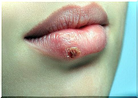 Herpes: prevention and natural treatments