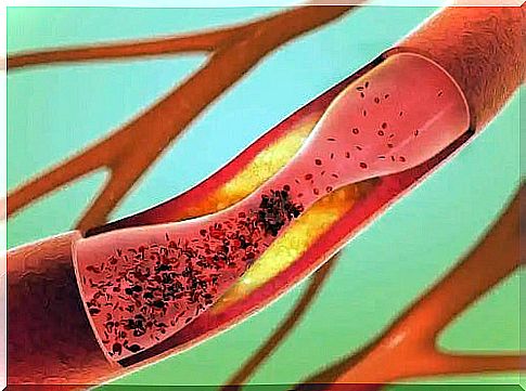 High blood lipids or hyperlipidemia