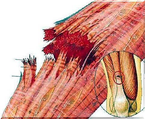 Drawing illustrating a broken muscle fiber