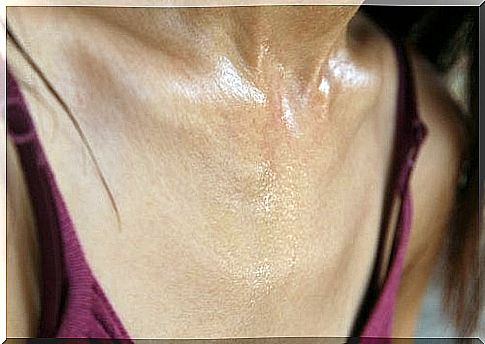 Myocardial infarction in women and sweating