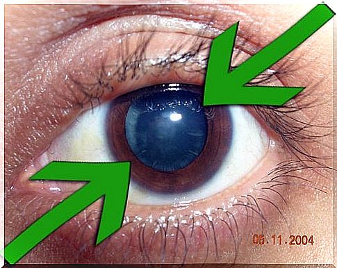 Natural remedies for cataracts