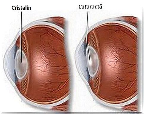 Eyes that need natural remedies for cataracts