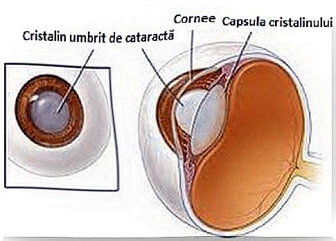 The need for natural remedies for cataracts