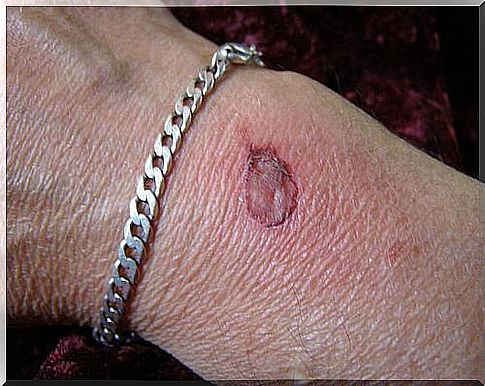 Natural remedies for burns located on the hands