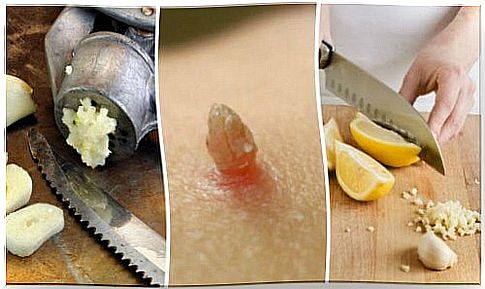 Natural treatment for warts with garlic and lemon