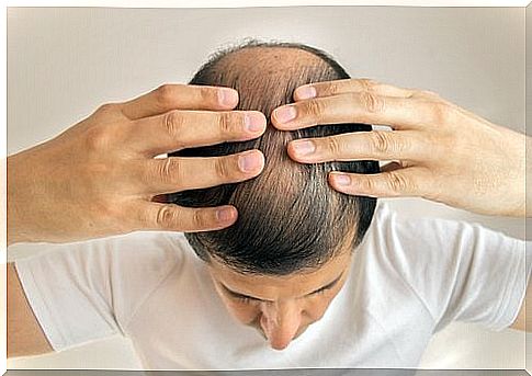 Alopecia may indicate that your liver is overworked