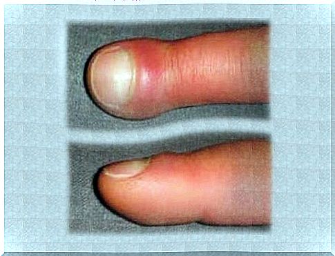 Swollen fingers - causes and remedies