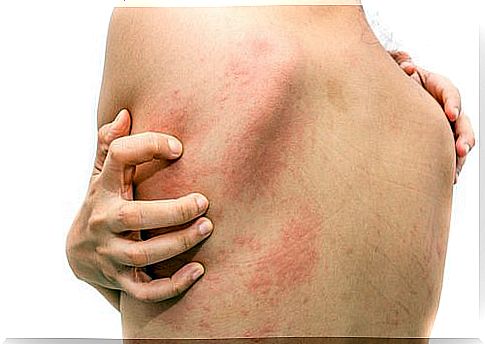 The best natural treatments for hives