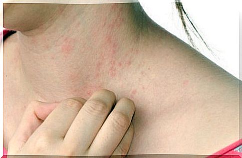 Woman with hives