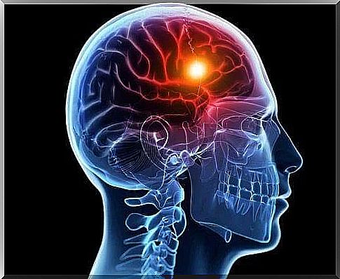 Drawing illustrating what is cerebral hypoxia