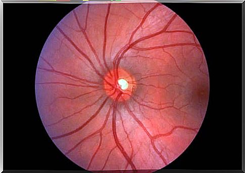 Image showing what is papillary edema